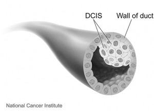 Illustration of DCIS cells